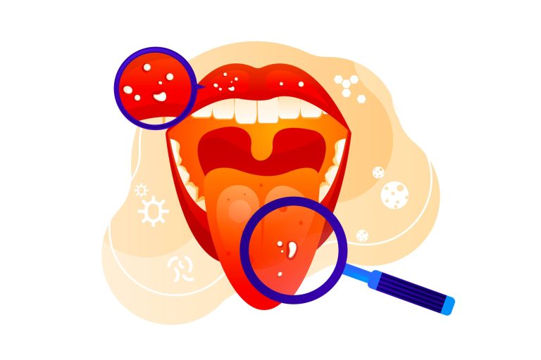 Clinical oral cancer illustration showing abnormal lesions in the mouth, highlighting early warning signs of oral malignancy.